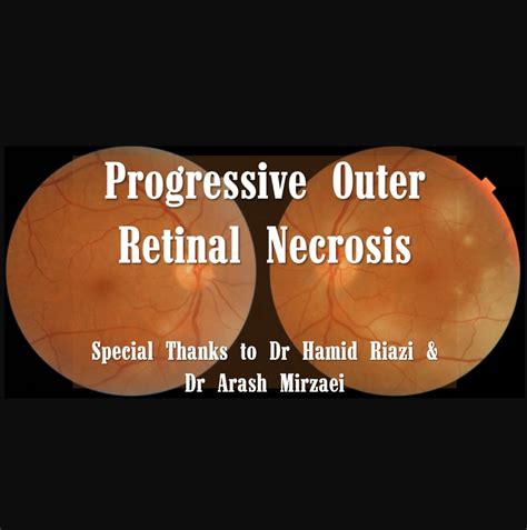 Avascular necrosis of the femoral head. Progressive Outer Retinal Necrosis - Farabi Retina