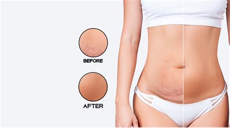 So how much does an tummy tuck cost? 壮大 Liposuction Before And After Pictures - サンセゴメ