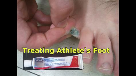 The fungal infection generally causes a burning and/ or itching sensation in the infected area. Athlete's Foot: What is it, how to treat it and how to ...