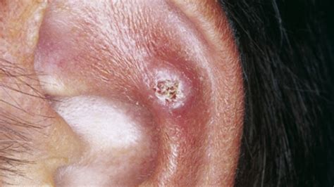 It causes a painful bump to develop on the top rim or helix of sleep on the other side to avoid putting pressure on the nodule. Chondrodermatitis Nodularis Helicis: Symptoms and More