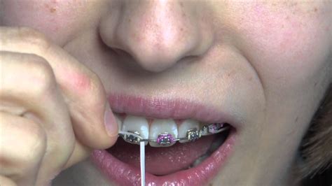 We provide floss threaders when you start braces or first get a permanent retainer. Cleaning your braces with floss threaders - YouTube