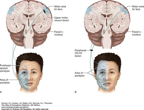 The weakness makes half of your face appear to droop. Related image | Motor neuron, Forehead, Neurons
