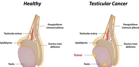 The most common symptom of testicular cancer is a lump in one or both testicles. Testicular Cancer | Modern Cancer Hospital Guangzhou, China