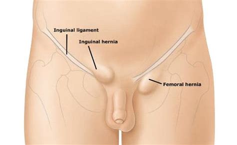 In human anatomy, the groin (the adjective is inguinal, as in inguinal canal) is the junctional area (also known as the inguinal region) between the abdomen and the thigh on either side of the pubic bone. Inguinal hernia - Symptoms and causes