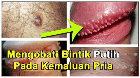 Bintik hitam bisa jadi terjadi karena jerawat yang membekas dan ini perlu upaya yang cukup besar untuk bisa menghilangkannya. Cara Menghilangkan Bintik Putih Pada Kemaluan Pria - YouTube