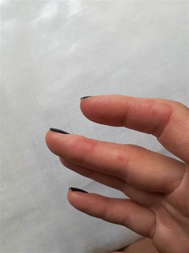 Диета при экссудативной эритеме Лечение и профилактика многоформной экссудативной эритемы Наталия Лечение и профилактика многоформной экссудативной эритемы Наталия Диета при экссудативной эритеме