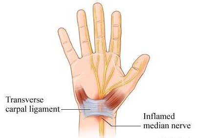 Metaanalysis for the evaluation of risk factors for carpal tunnel syndrome (cts) part ii. What Is Carpal Tunnel Syndrome?