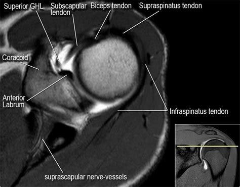 The undersurface of the supraspinatus tendon should be smooth. The Radiology Assistant : Shoulder MR - Anatomy ...