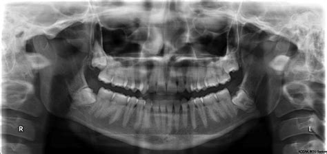 Dating is a stage of romantic relationships practised in western societies whereby two people meet socially with the aim of each assessing the other's suitability as a prospective partner in a future. Dating a damaged mandibular. Mandible - Wikipedia