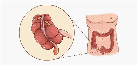 #맹장염 으로 알려져 있는 #충수염 에도 전형적인 증상 변화가 있습니다. 구리 윤서병원