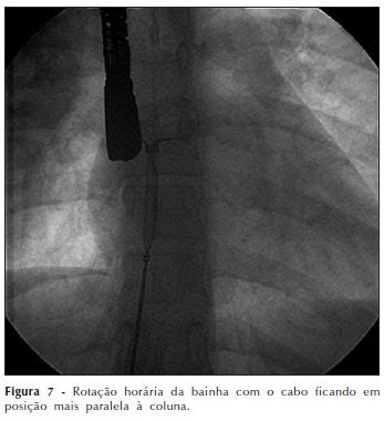 The septum primum eventually fuses with the endocardial cushion, closing the ostium primum off completely. Experiência inicial no fechamento percutâneo da ...