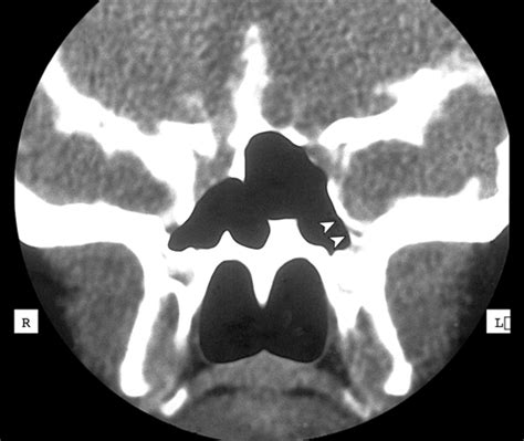 Endonasal Endoscopic Repair of Cerebrospinal Fluid Leaks ...