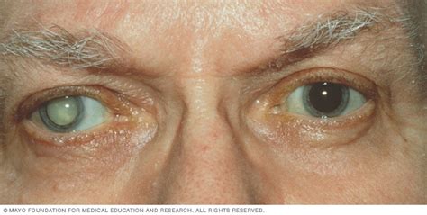 You won't feel any pain during the procedure, and it usually only takes about 15 minutes. Cataracts - Symptoms and causes - Mayo Clinic