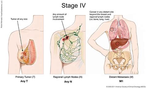 Consultant medical oncologist sanjay popat explains what mesothelioma (cancer of the mesothelium) is, including plural mesothelioma (in the lung). 18 Precautions You Must Take Before Attending How Does Can ...