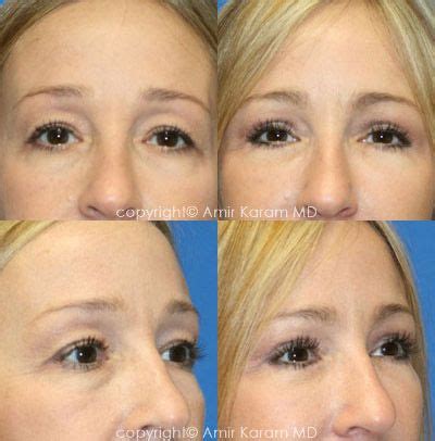 Eye Rejuvenation | Rejuvenation, Eyelid surgery, San diego