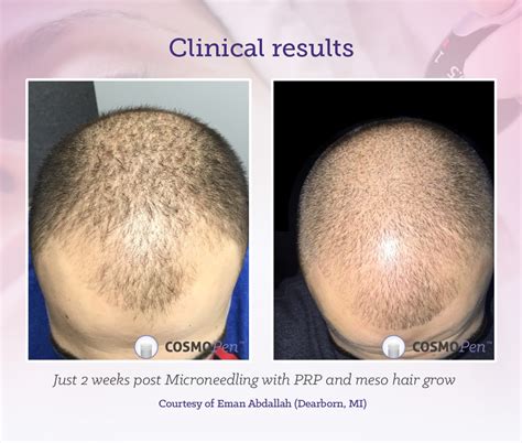 Response to microneedling treatment in men with androgenetic alopecia who failed to respond to a randomized evaluator blinded study of effect of microneedling in androgenetic alopecia: Micro Needling For Hair Loss | Spefashion