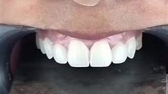 Everything is just perfect ❤️ . . #transformation #dentist #veneers #hollywoodsmile #teethwhitening #braces #dentalimplants | Nassef Dental Care