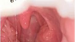 Tonsil stone removal tips #tonsilstonesremoval #holdmymilk #oddlysatisfying #tonsils #tonsiltok #tonsillstone #reels2023 | Nika Diwa
