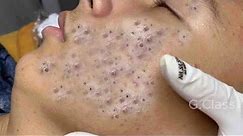 Skin care to remove severe blackheads#997