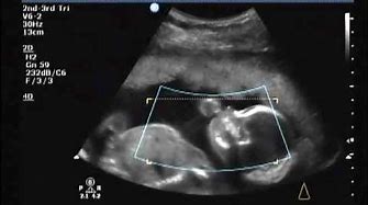 20 week ultrasound.....It's A GIRL!!!!!