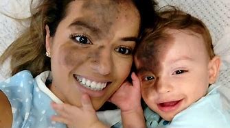 Mom Uses Makeup to Match Son's Facial Birthmark