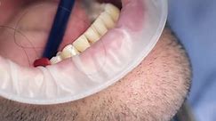 Dental Tooth Implantation Dental Gum Grafting As Preparation for Dental Implant Installation Dental