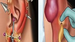 Satisfied!! Treat Infected Ear Keloid Caused By Rusty Earrings & Poor Hygiene - Piercing Cleaning