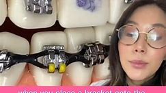 Attaching braces bracket. #braces #brackets #orthodontics #dentist | Dr. Joyce Kahng