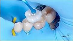 Veneer Applicators Tips 🔝#teeth#tooth#toothless#extraction#cirugiabucal#oralsurgery#dental#dentist#dentistry#matteonegri#dentalhygiene#dentalassistant#dentalschool#dentalstudent#dentalhygiene#implant#dentist#odonto#odontogram#odontologo#odontolove#odontología#odontologia#odontogram#odontoporamor#estomatología#prosthesis#prosthodontics#ortho#braces#smile#drawing @toshinari_toyama 🦷😷 | Dental Mentor