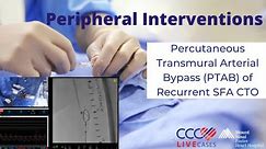 Percutaneous Transmural Arterial Bypass (PTAB) of Recurrent SFA CTO