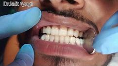 dental scaling tobacco stains