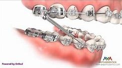 Orthodontic Treatment for Overjet Overbite Forsus Appliance