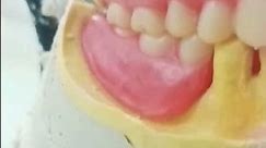 upper complete lower partial denture tooth set up #dental #dentist