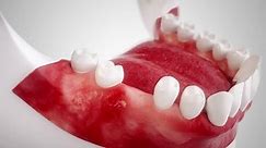 Dental Implant High End 3d Animation Stock Footage Video (100% Royalty-free) 28809328 | Shutterstock