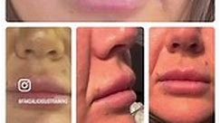 Overfilled lips? Or Too... - Fakealicious Training Academy