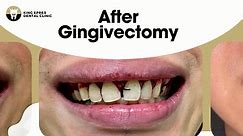 Check out the before-and-after... - King Epres Dental Clinic