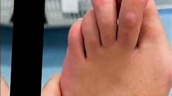 Foot surgery in Morocco #podiatry #pedicure #footsurgeon #footandanklesurgery #orthopedicsurgeon