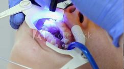 Orthodontist fixes ligature braces on teeth of client. Close up of teen at appointment in dental clinic. Concept of orthodontic treatment and dentistry